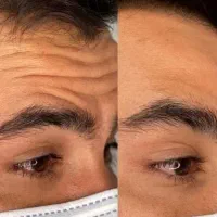 ژل،بوتاکس،مزوتراپی مو صورت،آنزیم،فیلرلب|خدمات آرایشگری و زیبایی|کرج, ساماندهی|دیوار