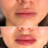بوتاکس صورت ۸۰۰ تومان ژل لب گونه۹۵۰تخفیف ویژه