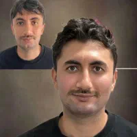 ژل بوتاکس اقایان و بانوان خانم سلطانی|خدمات زیبایی و سلامت|تبریز, |دیوار