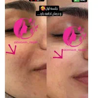 جشنواره پاییزمزوتراپی مزونیدلینگ و پی ارپی پوست مو|خدمات آرایشگری و زیبایی|اصفهان, دانشگاه اصفهان|دیوار