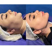 بی نظیرترین سوپرکانتورینگ غبغب با سابقه 8000جراحی