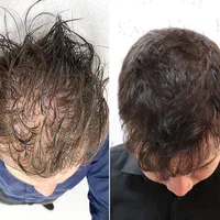 پی آر پی *بدون‌درد* prp قطع ریزش مو با ضمانت  365ت|خدمات آرایشگری و زیبایی|تبریز, |دیوار