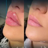 جشنواره ۵۰ درصد تخفیف ژل لب بوتاکس فیلر نخ لیفت|خدمات آرایشگری و زیبایی|اصفهان, رزمندگان|دیوار
