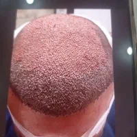 کاشت مو طبیعی در شهر بافق