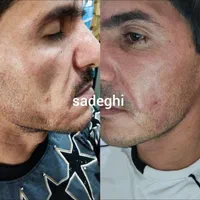 ژل وبوتاکس.چربی سوز.انزیم.فشیال.پیرسینگ|خدمات آرایشگری و زیبایی|اصفهان, احمدآباد|دیوار