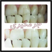 روکش دندان سرامیکی