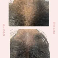 فیلر،بوتاکس،مزوتراپی،عصاره سلول بنیادی توسط پزشک