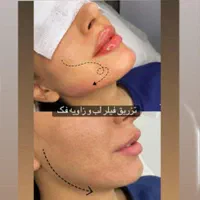 مرکز تخصصی تزریق چربی/فیلرلب و صورت/نخ لیفت/بوتاکس|خدمات آرایشگری و زیبایی|مشهد, سجاد شهر|دیوار