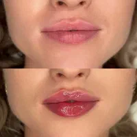 تزریق ژل (فیلر)وبوتاکس لیفت با نخ‌ مادلینگ درشرق