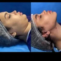 مرکزلیپوساکشن و ساکشن غبغب و زاویه سازی توسط جراح|خدمات آرایشگری و زیبایی|مشهد, سناباد|دیوار