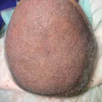 انجام خدمات کاشت مو