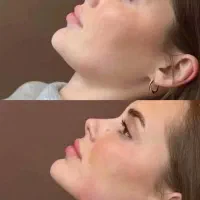 ژل لب فقط ۸۹۰ جشنواره  ویژه در کلینیک