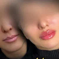 ژل و بوتاکس