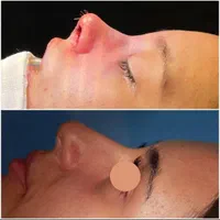 جراحی و عمل زیبایی بینی ( رینو پلاستی )|خدمات آرایشگری و زیبایی|کرج, گوهردشت|دیوار