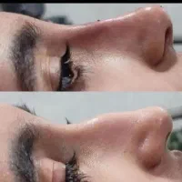 تزریق فیلر و زیبایی و مزو ژل