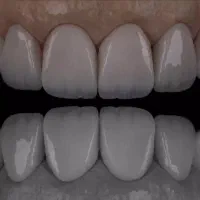 کامپوزیت دیجیتال و لمینیت با شرایط استثنایی در لار|خدمات آرایشگری و زیبایی|لار, |دیوار