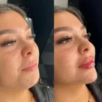 مزونیدلینگ ژل و بوتاکس|خدمات آرایشگری و زیبایی|یاسوج, |دیوار