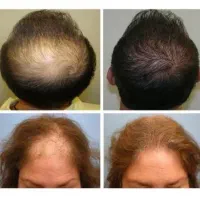 PRGF|خدمات آرایشگری و زیبایی|مشهد, فردوسی|دیوار