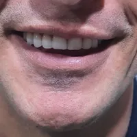 ساخت انواع دندان مصنوعی ژله‌ای آلمانی|خدمات آرایشگری و زیبایی|کرج, آزادگان|دیوار