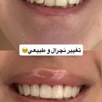 تخفیف ویژه کامپوزیت واحدی۱۳۰۰ عصب کشی ۲میلیون