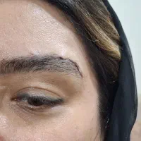 لابیاوتنگی و بلفاروپلاستی ولیفت شقیقه