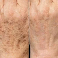 خال های گوشتی