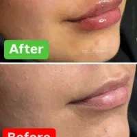 مدل رایگان ژل فیلر لب در مطب زیبایی پزشکی
