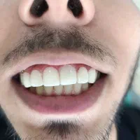 روکش دندان ، کامپوزیت|خدمات آرایشگری و زیبایی|تهران, تهرانسر غربی|دیوار