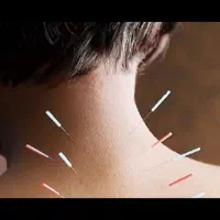طب سوزنی (چینی)|خدمات آرایشگری و زیبایی|اهواز, فرهنگ شهر|دیوار