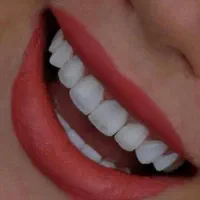 کامپوزیت دندان|خدمات آرایشگری و زیبایی|آبادان, |دیوار