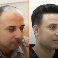 کاشت مو|خدمات آرایشگری و زیبایی|شیراز, قصرالدشت|دیوار