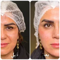 رفع خط خنده عمیق با تزریق فیلر توسط پزشک ،اقساطی
