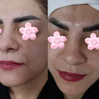 فیشال و پاکسازی  بانوان با 15%تخفیف