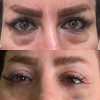 جراحی پلک و جراحی زیبایی