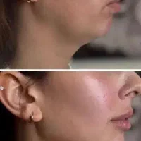 تزریق ژل فیلر بوتاکس مزو فیلر بادی قیمت استثنایی|خدمات زیبایی و سلامت|شیراز, فضل‌آباد|دیوار
