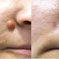 برداشتن خال ، خال گوشتی و میلیا فقط در یک جلسه