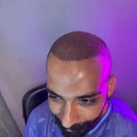 برای اولین بار کاشت مو با شرایط ویژه در رفسنجان