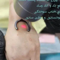 لیپوساکشن،غبغب،لیزرco2