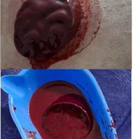 حجامت وفصد وزالودرمانی درمطب