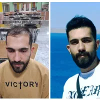 کاشت مو فقط با ۲ میلیون