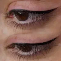 مرکز تخصصی پاک کردن تتو/میکرو،فیبروز ،شیدلب،آموزش|خدمات آرایشگری و زیبایی|گرگان, |دیوار