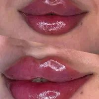 ژل،بوتاکس،پی آرپی،میکرونیدلینگ