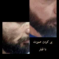 ویژه اقایان آف بوتاکس فیلر و پاکسازی|خدمات آرایشگری و زیبایی|کرج, گلشهر|دیوار