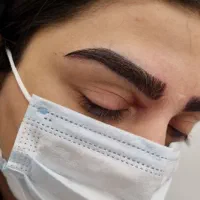 میکروکاشت بدون جراحی