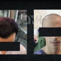 کاشت مو ابرو ریش طبیعی با تراکم بالا کلینیک رخ