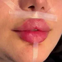 تزریق ژل و فیلر لب،گونه،چانه(جشنواره)درمطب فقط499ت|خدمات آرایشگری و زیبایی|اصفهان, باغ زیار|دیوار