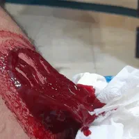 حجامت درمانی