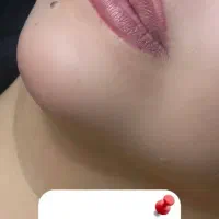 انجام تمامی خدمات فیلرو ساکشن و لابیا پلاستی|خدمات آرایشگری و زیبایی|کرمانشاه, |دیوار