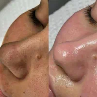 خدمات تخصصی پوست و زیبایی صورت ۵۰٪آف تا فردا|خدمات آرایشگری و زیبایی|مشهد, دانشجو|دیوار