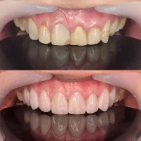 کامپوزیت دندانپزشکی اقساطی بدون پیش پرداخت